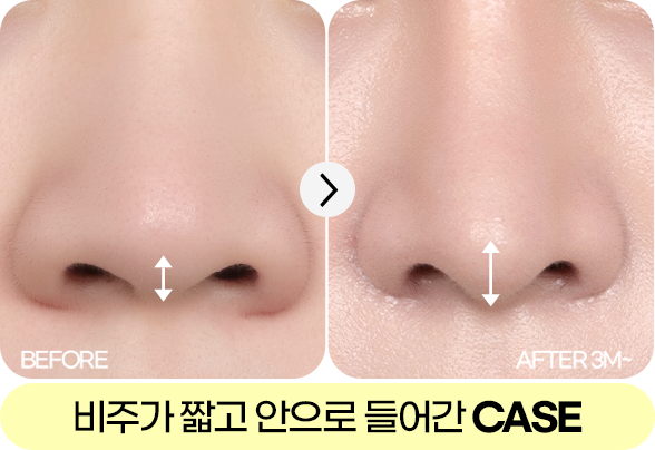 디에이 각도 코성형