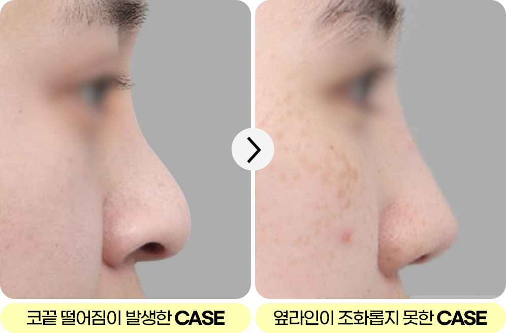 디에이 각도 코성형