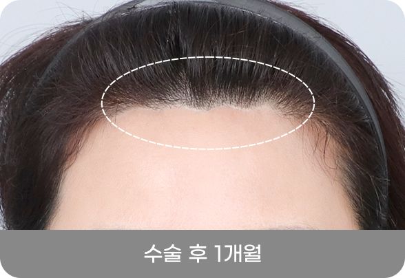 디에이 올아이 리프팅