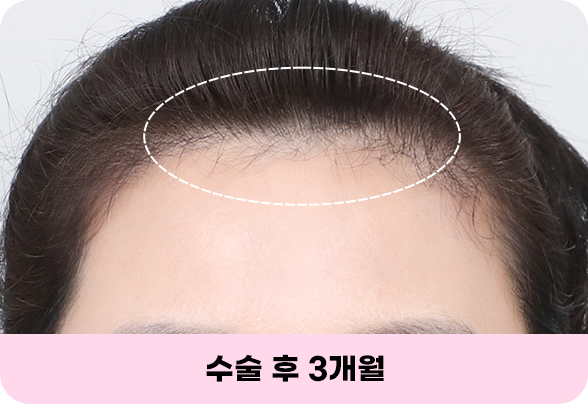 디에이 올아이 리프팅