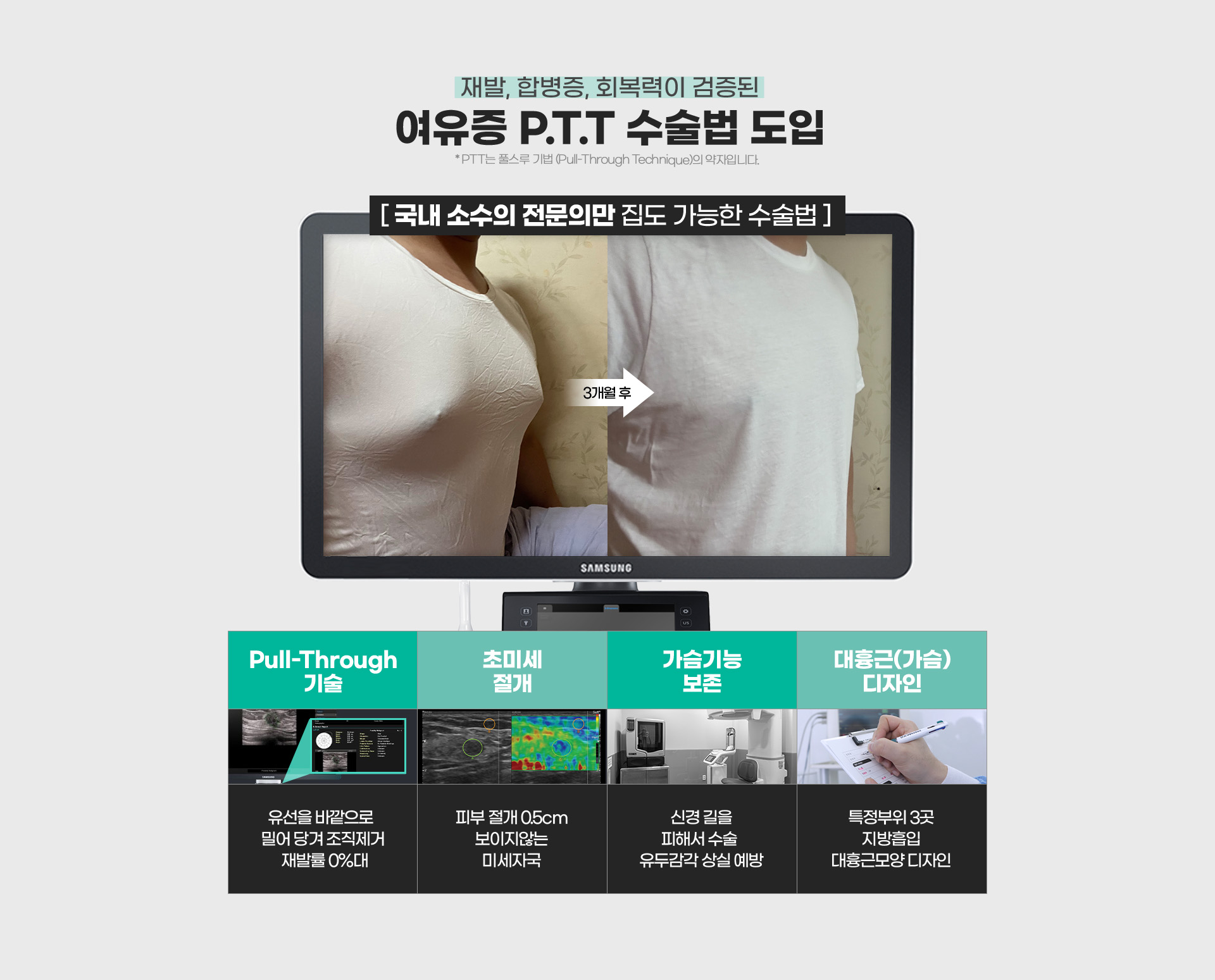 재발, 합병증, 회복력이 검증된 여유증 P.T.T 수술법 도입
