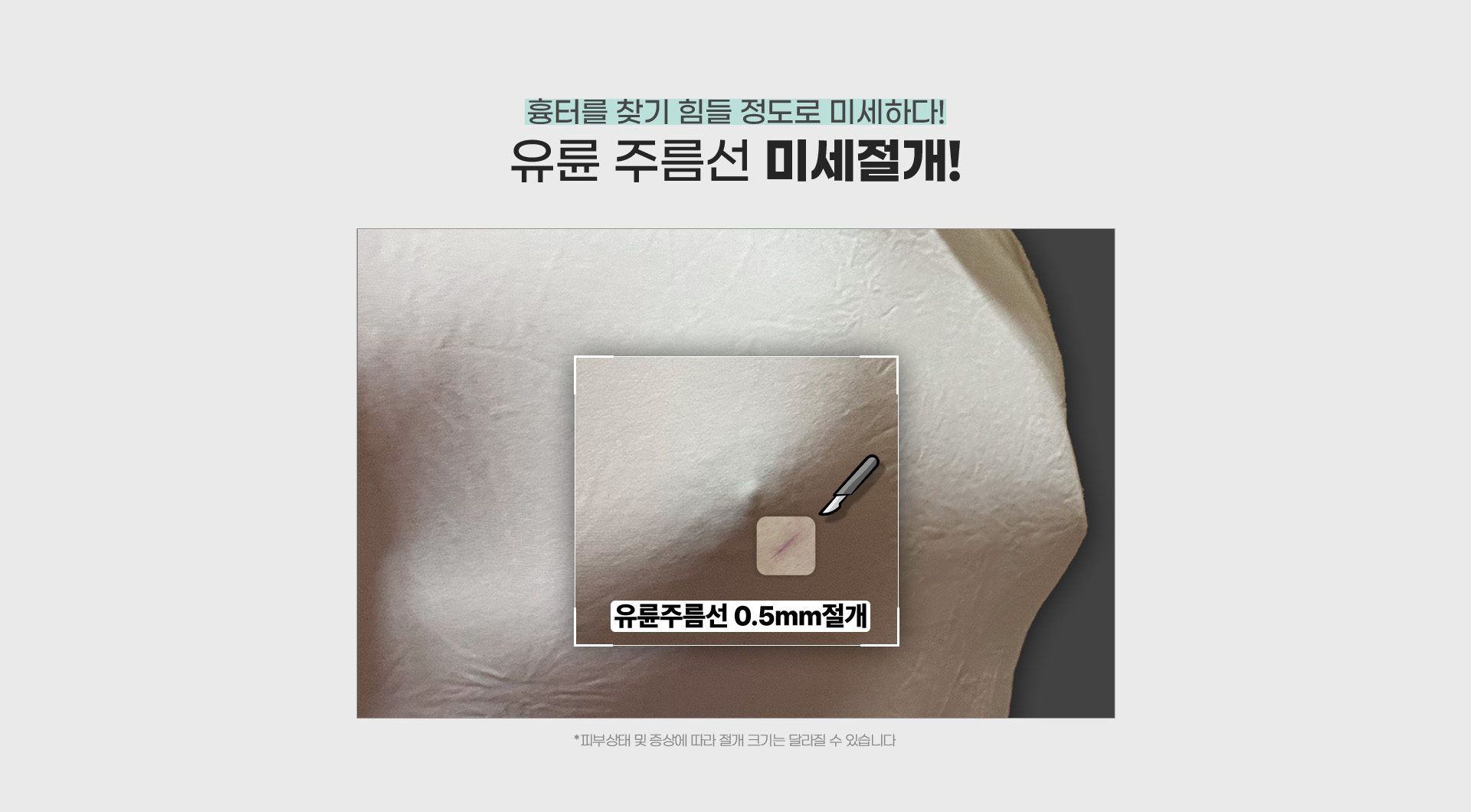 흉터를 찾기 힘들 정도로 미세하다! 유륜 주름선 미세절개!