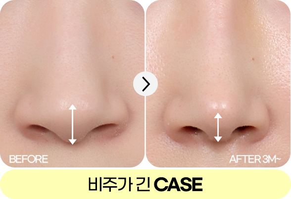 자려한코성형 CASE