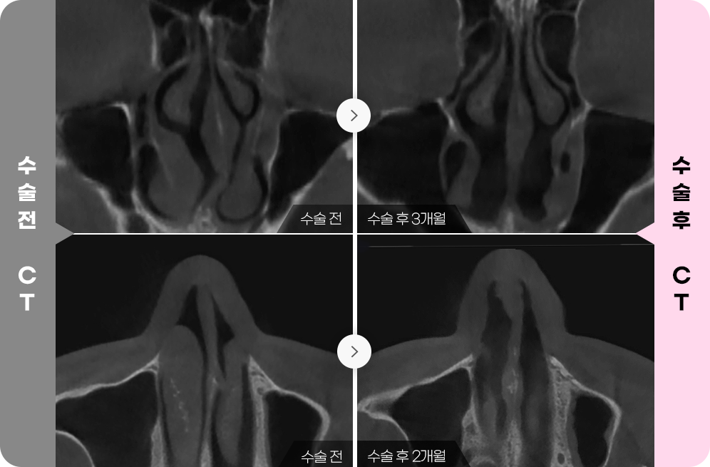 디에이 비염미용코성형