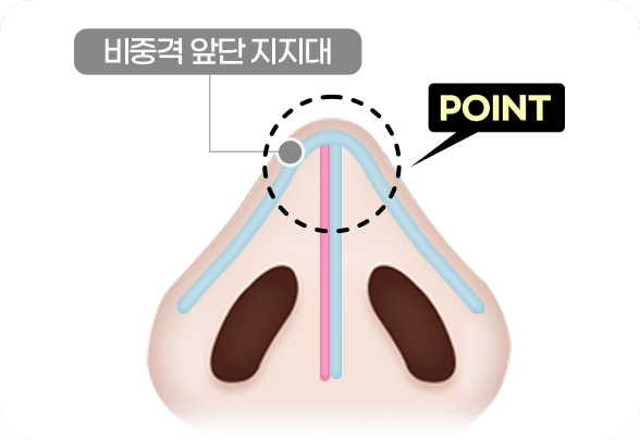 디에이 코 재수술