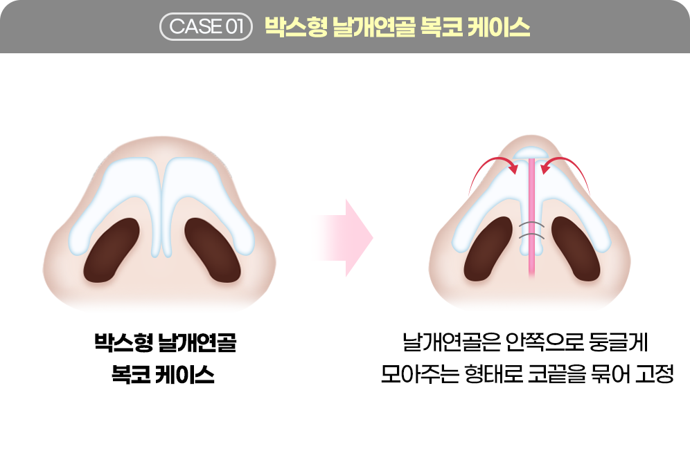 디에이 코 재수술