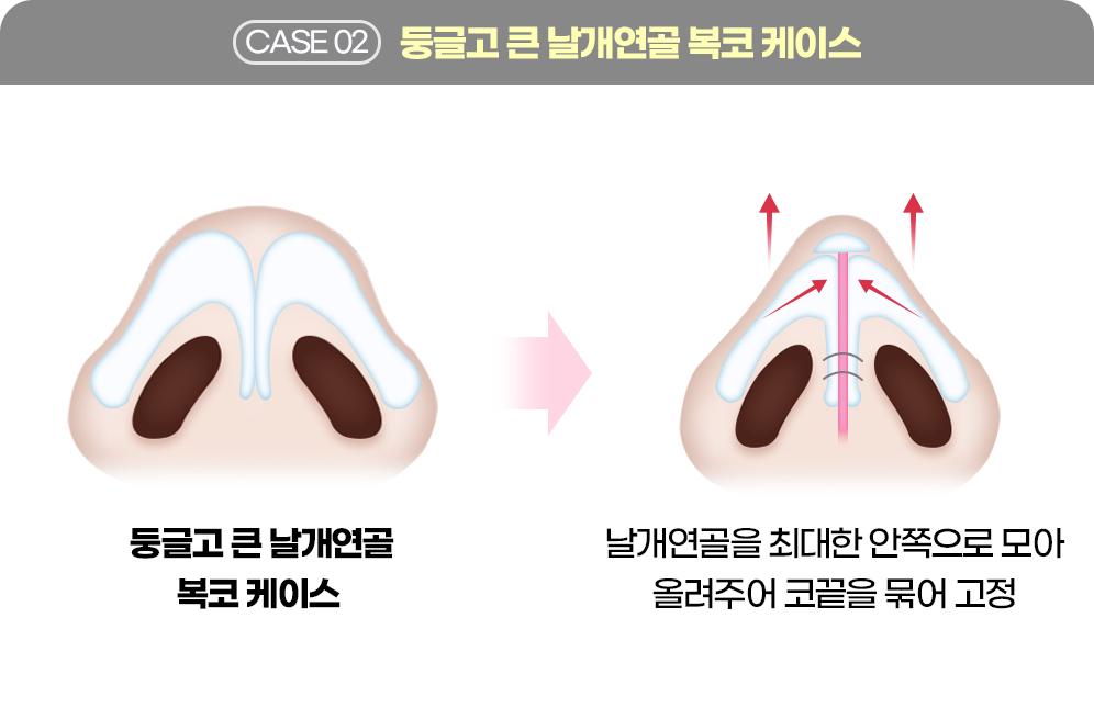 디에이 코 재수술