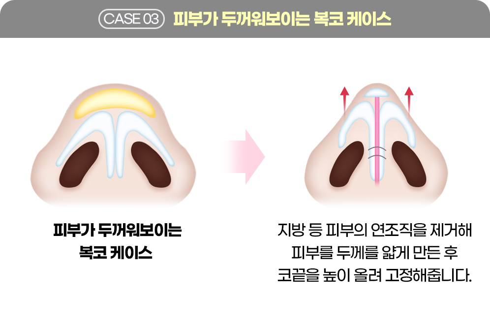 디에이 코 재수술