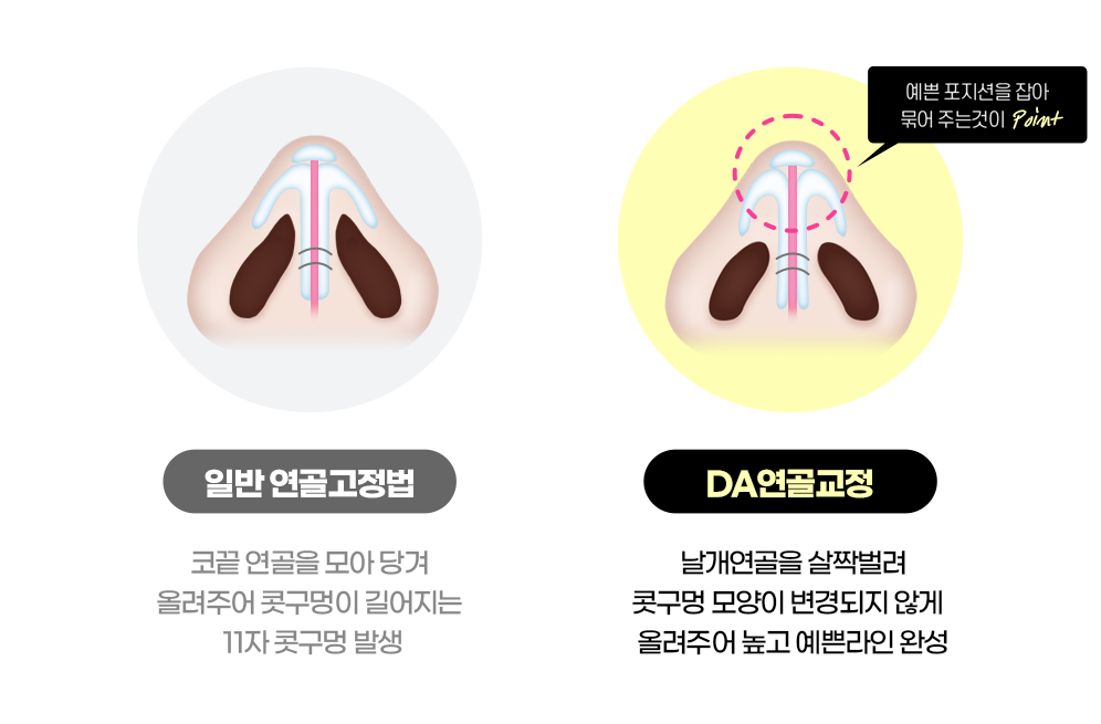 디에이 코 재수술