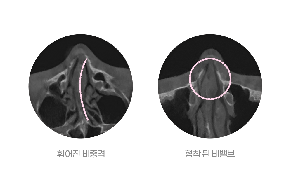 디에이 비염미용 코재수술