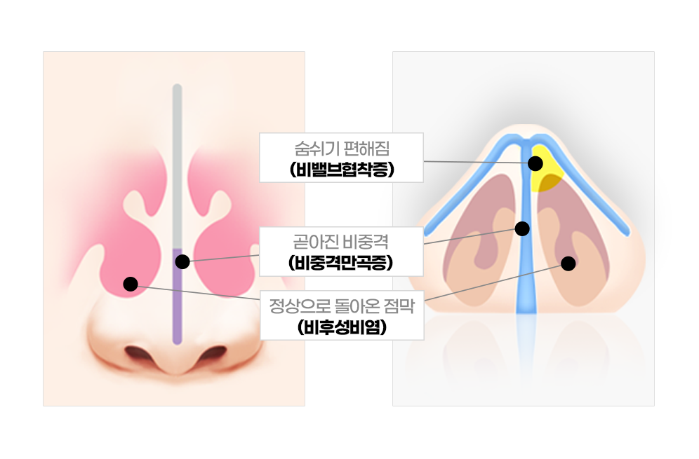 디에이 비염미용 코재수술