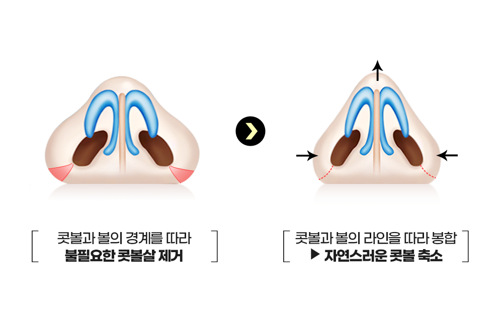 디에이 콧볼축소