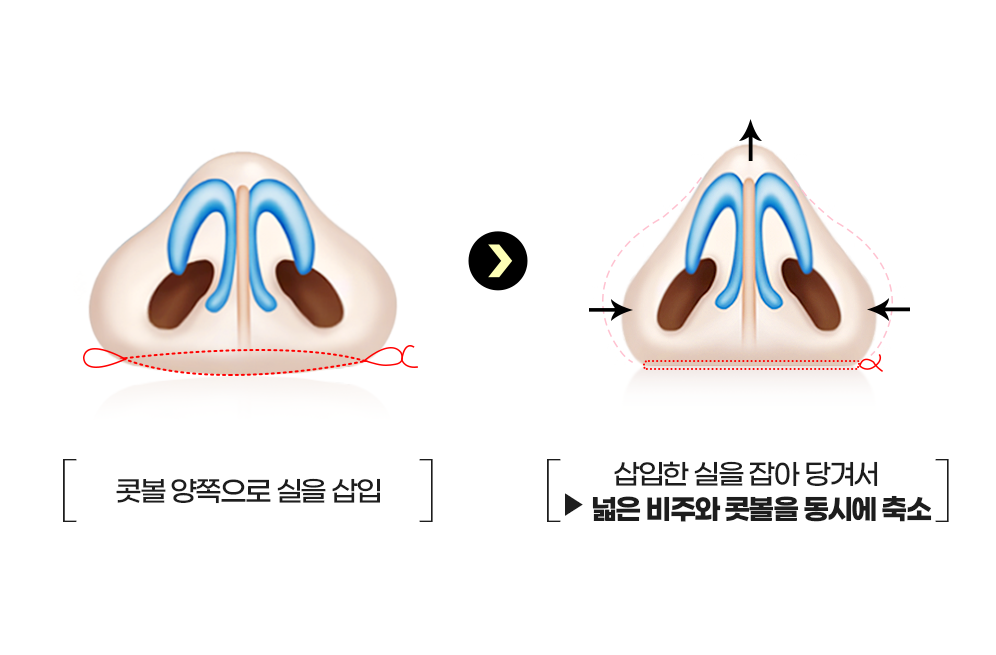 디에이 콧볼축소