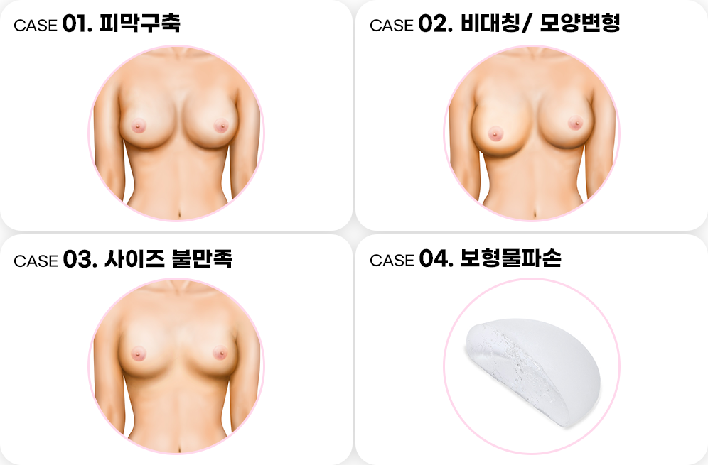 디에이 가슴 재수술