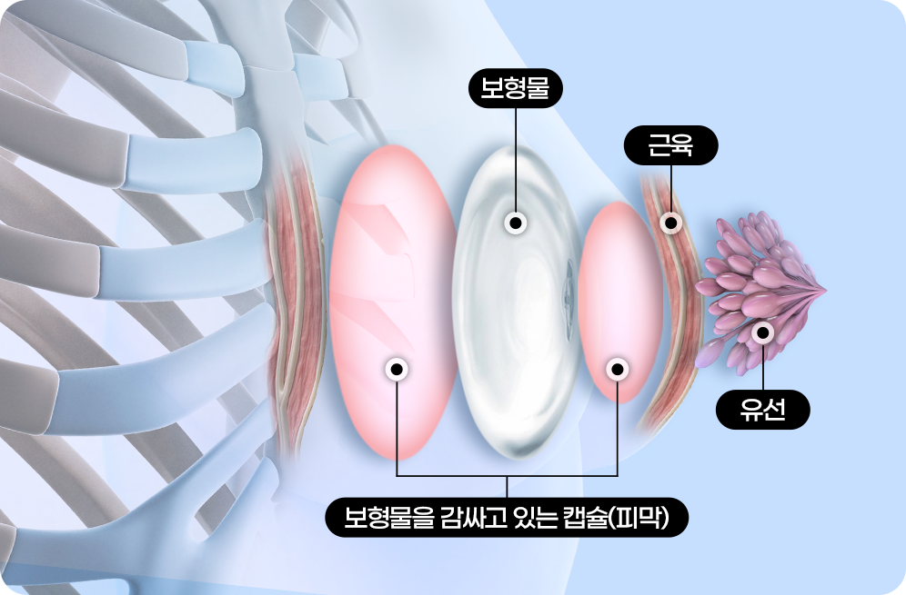 디에이 가슴 재수술