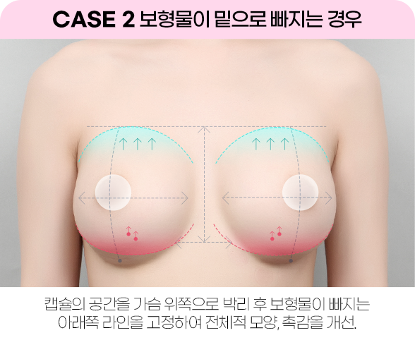 디에이 가슴 재수술