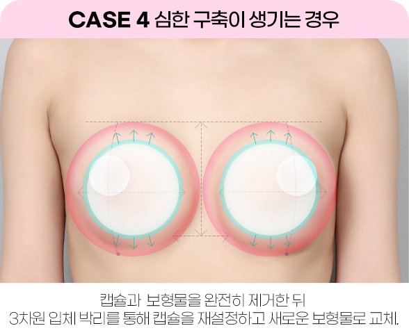 디에이 가슴 재수술