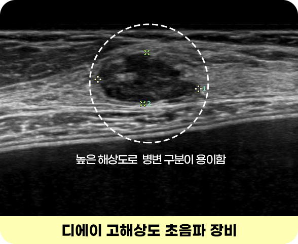 디에이 유방정밀검진