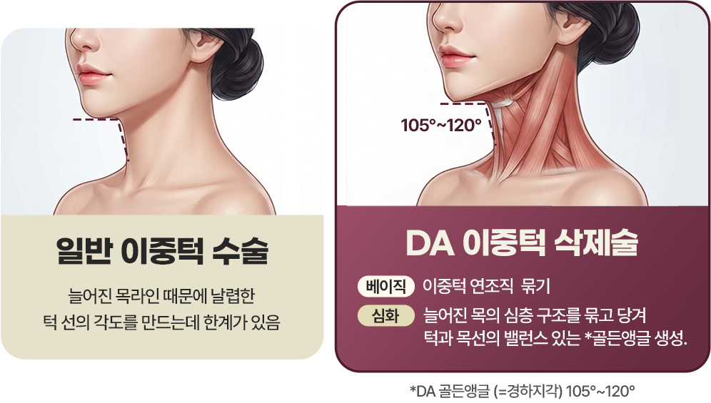 디에이 이중턱 삭제술