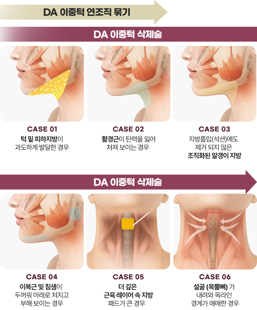 디에이 이중턱 삭제술