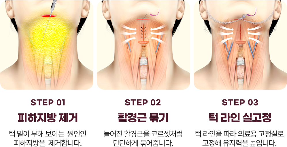 이중턱 삭제술