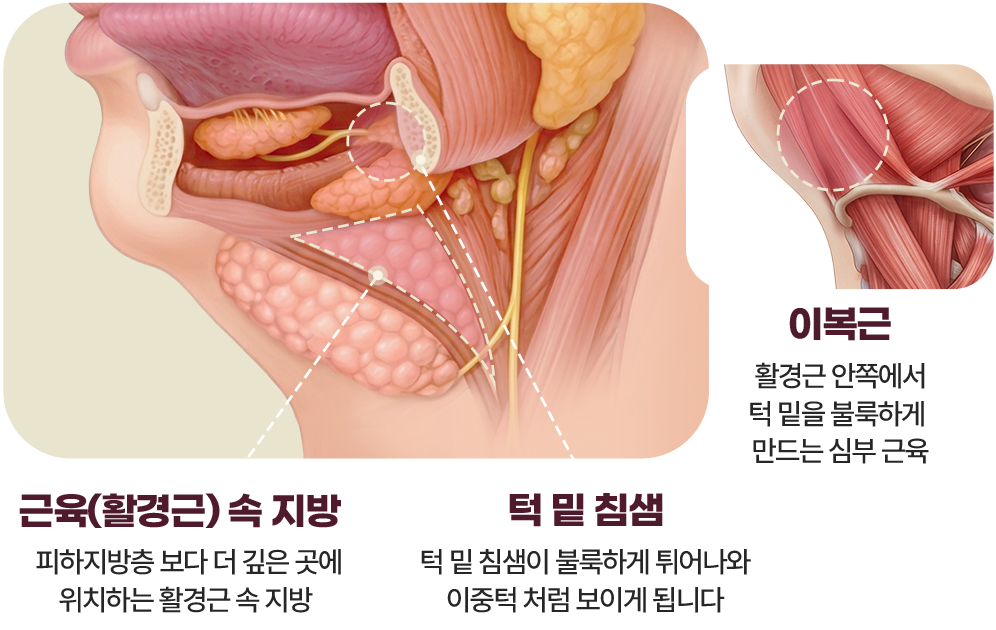 이중턱 삭제술