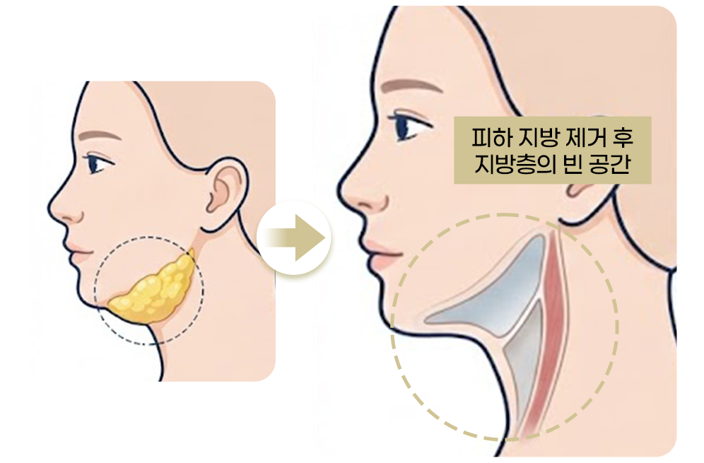 연조직 이중턱 근육묶기
