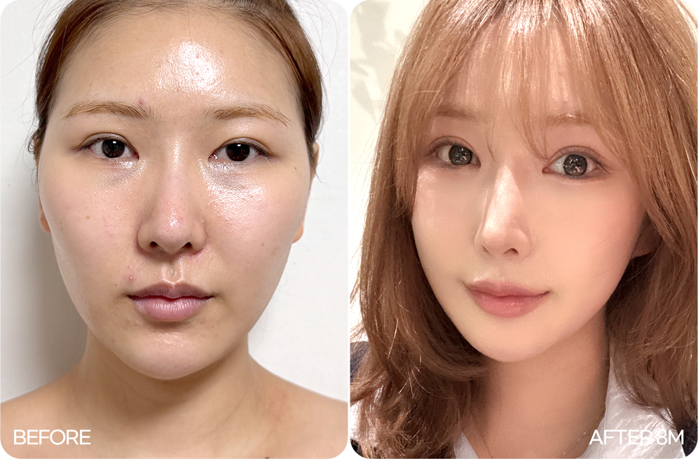 연조직 이중턱 근육묶기