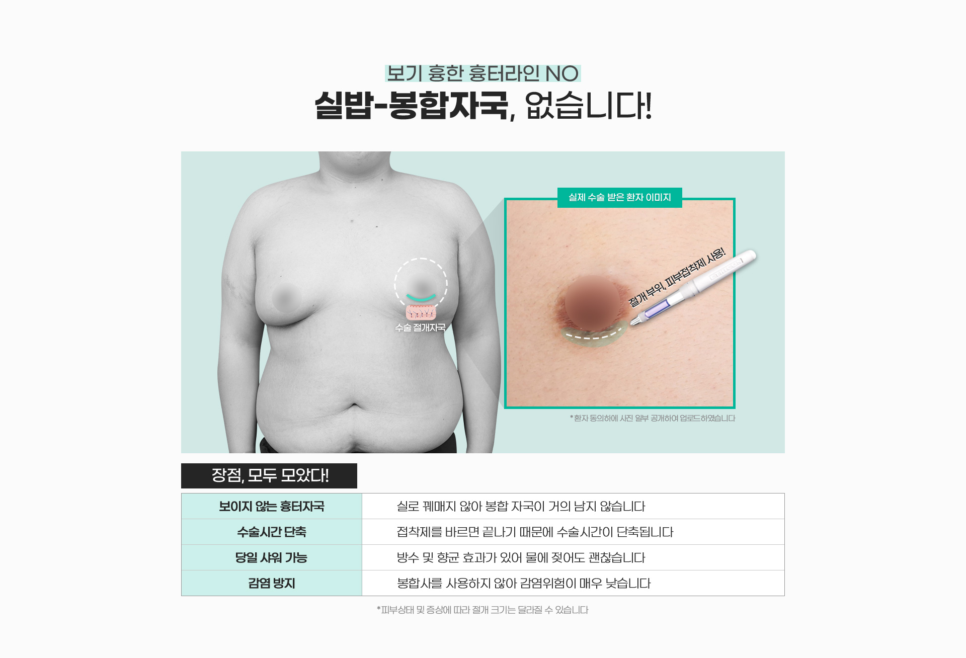 보기 흉한 흉터라인 NO 실밥 / 봉합자국, DA 없습니다!