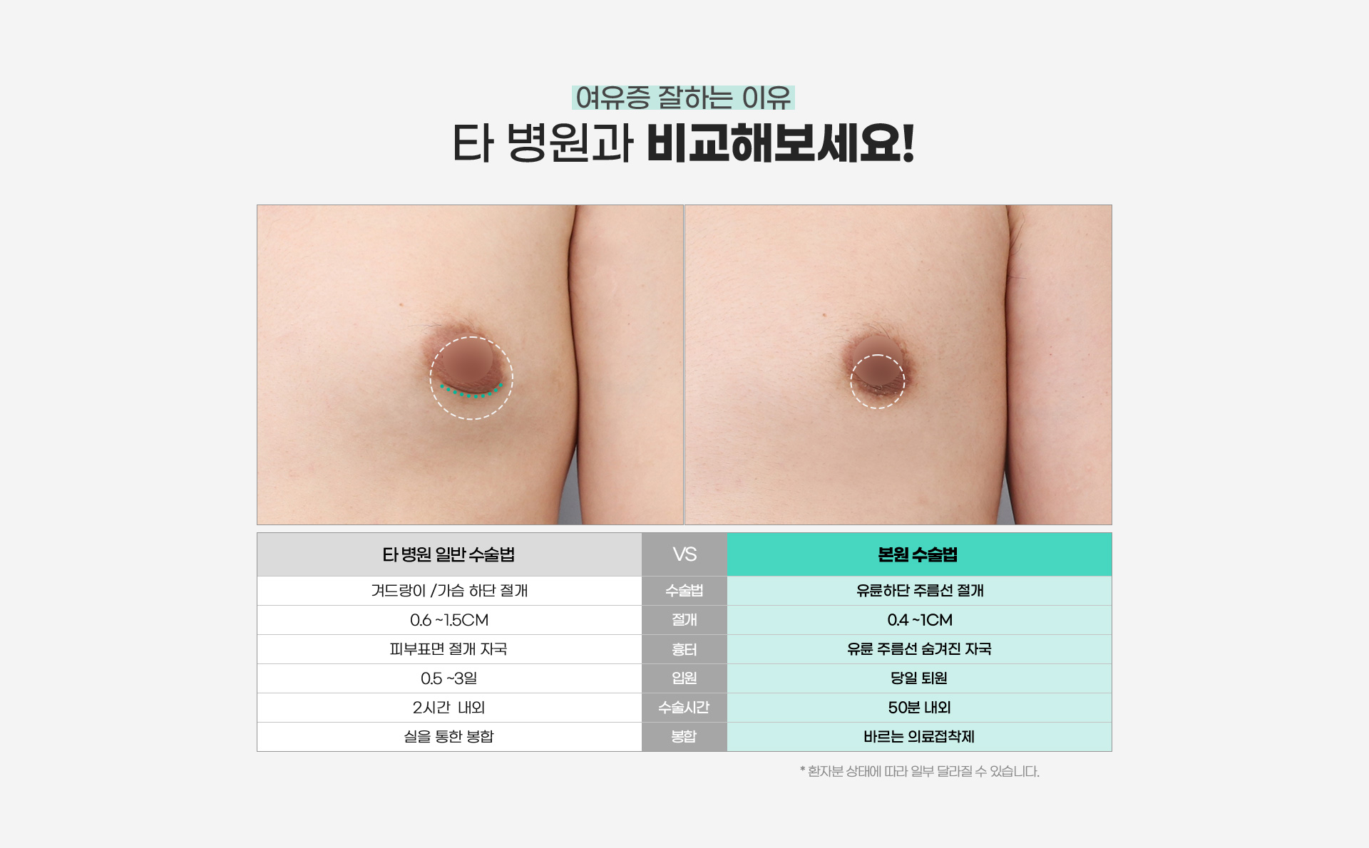 여유증 디에이가 잘하는 이유 타 병원과 DA 비교해보세요!