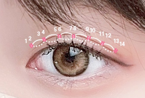비절개(자연유착) 14개 유착 포인트 위치를 번호로 표시한 눈꺼풀 사진